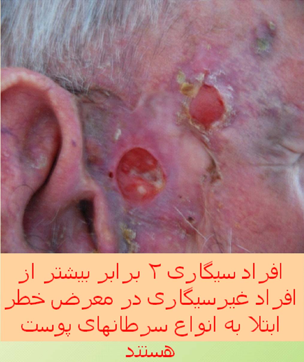 Iran 2009 Health Effects Other - skin cancer, lived experience